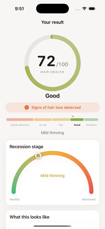 keratin result screen with a Hair Health score of 72 and a recession-stage gauge